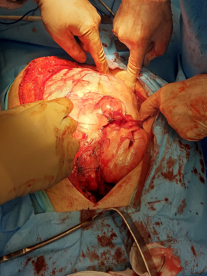 Removal of 7 kidney masses from my abdomen