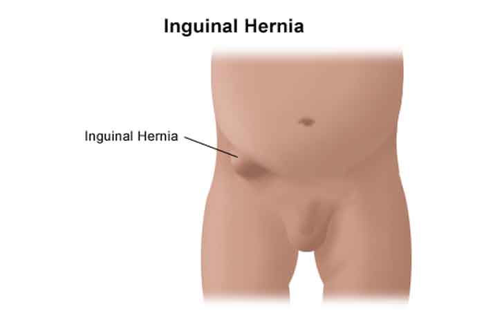 Hernia Surgery Recovery