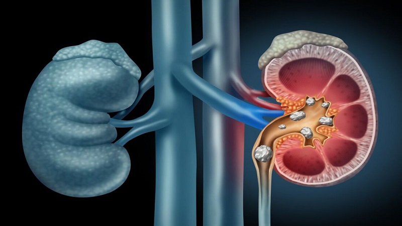 Chronic kidney failure