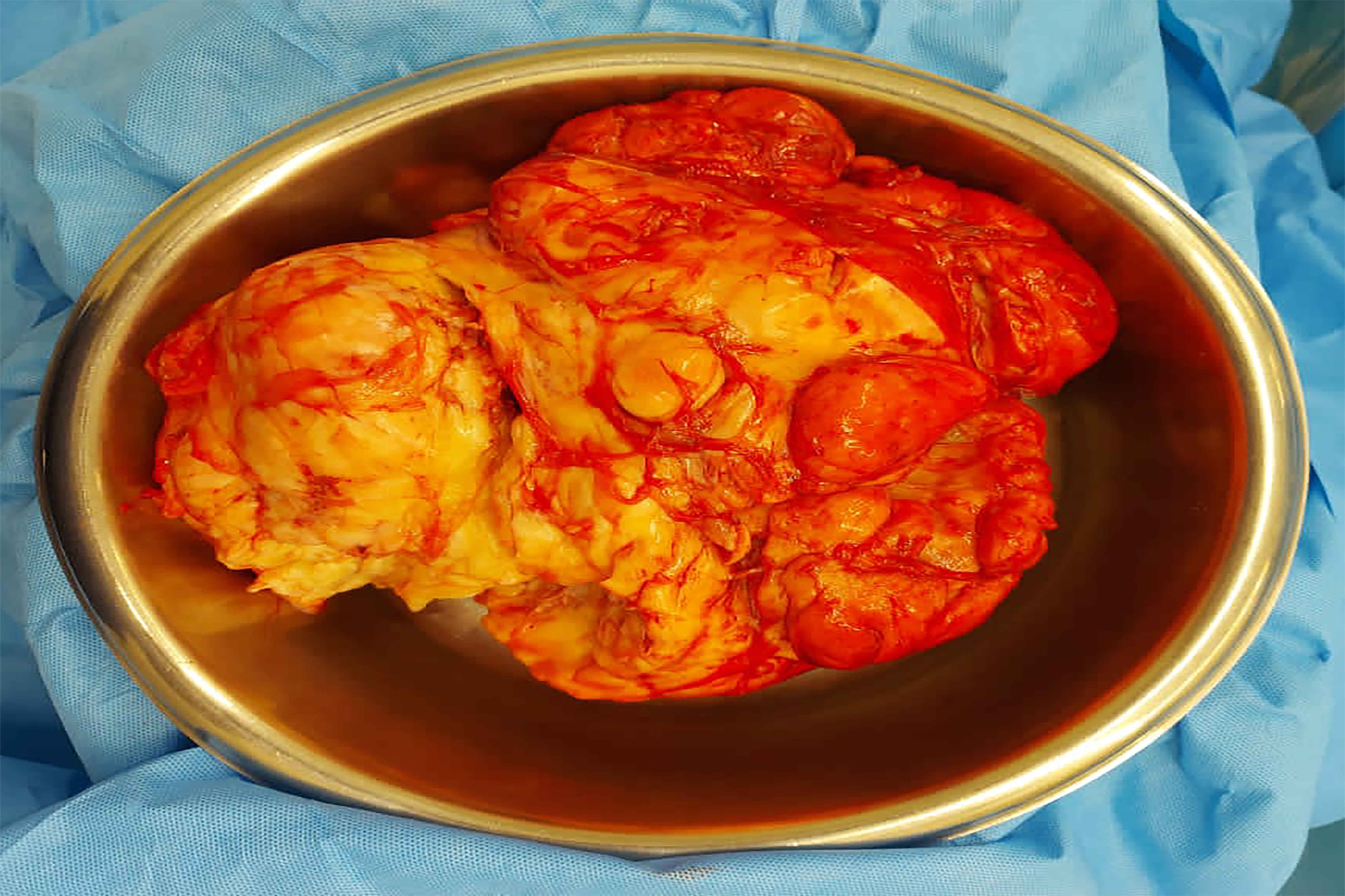 The successful surgical removal of a 7-kilogram tumor